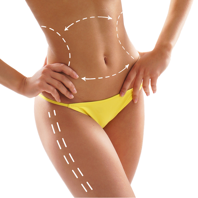 Abdominoplastia